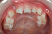 写真３ 前歯部の平坦化