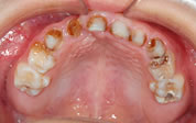 写真９ 重度の虫歯
